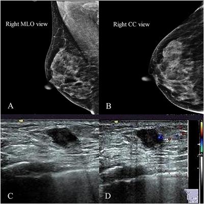 Change of Pathological Type to Metaplastic Squamous Cell Carcinoma of the Breast During Disease Recurrence: Case Report and Literature Review